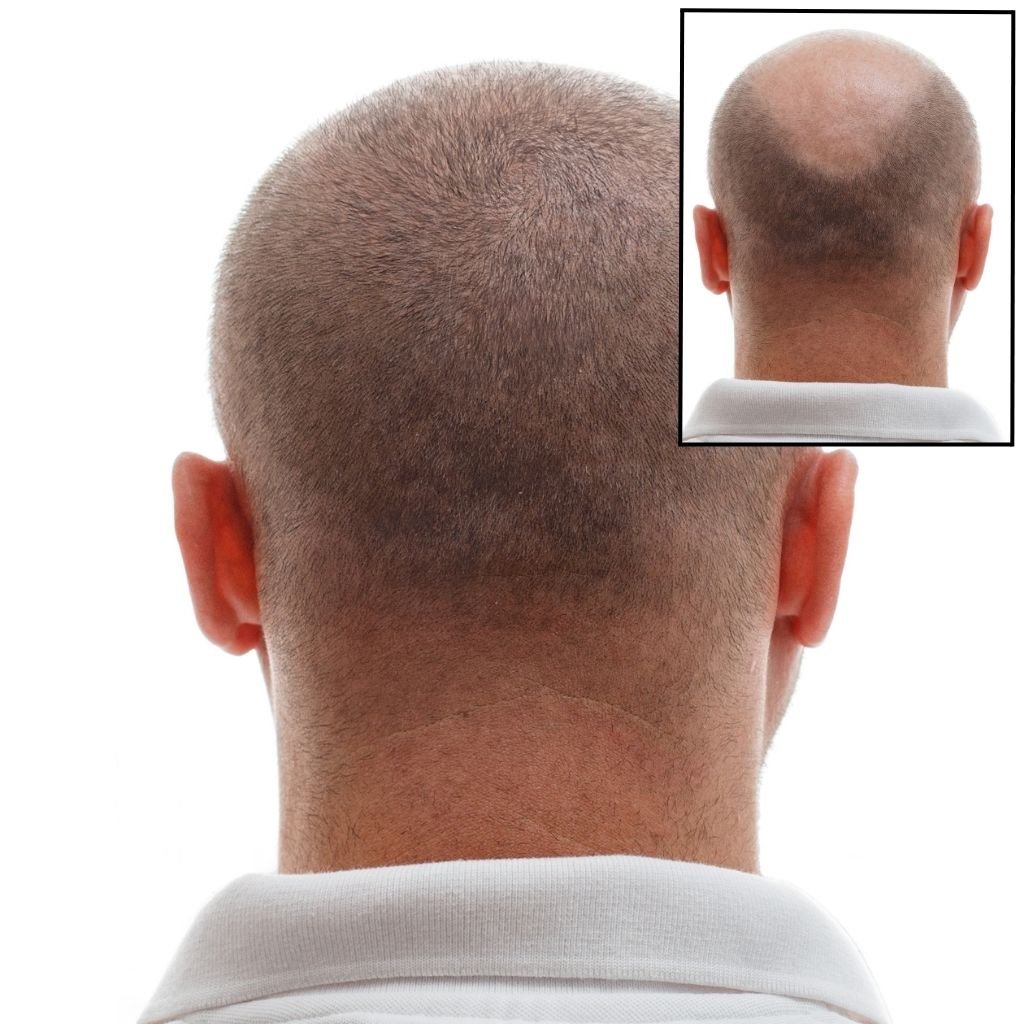 A man's hair transplant results.