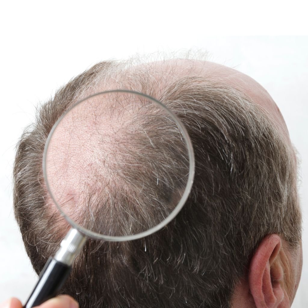 A man's balding head beneath a magnifying glass.