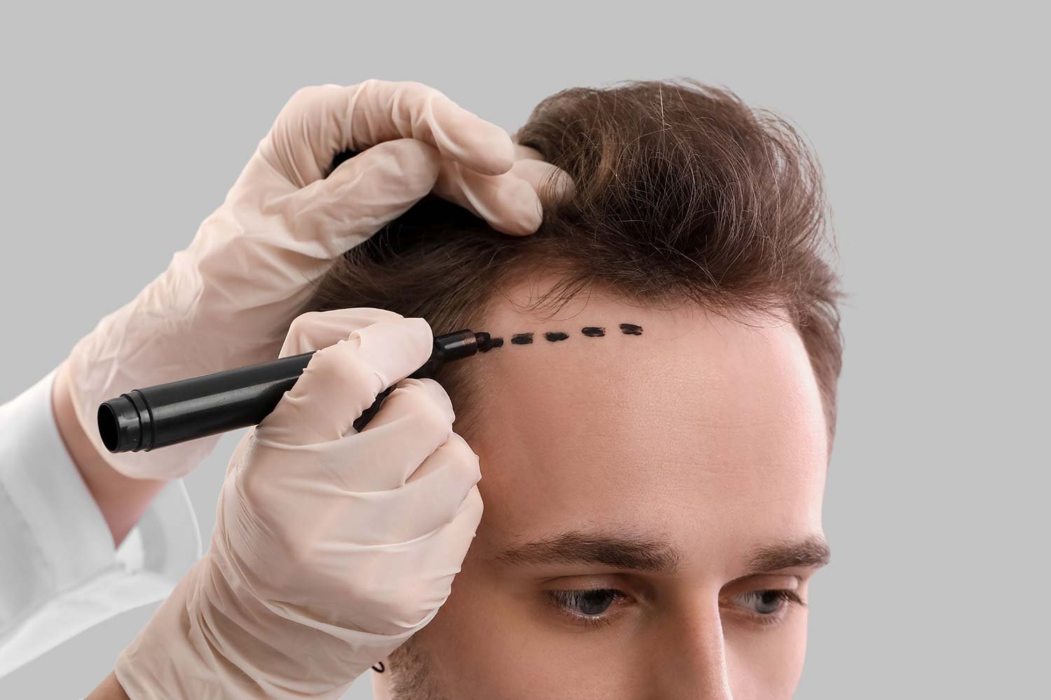 Debunking Common Myths About Hair Transplants