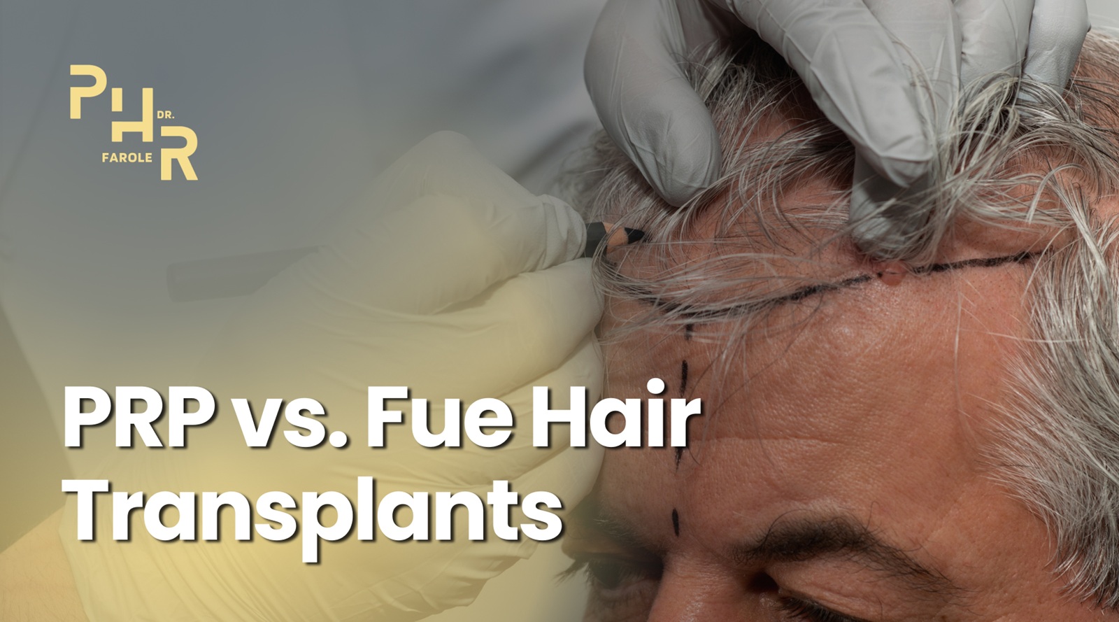 PRP vs. FUE Hair Transplants