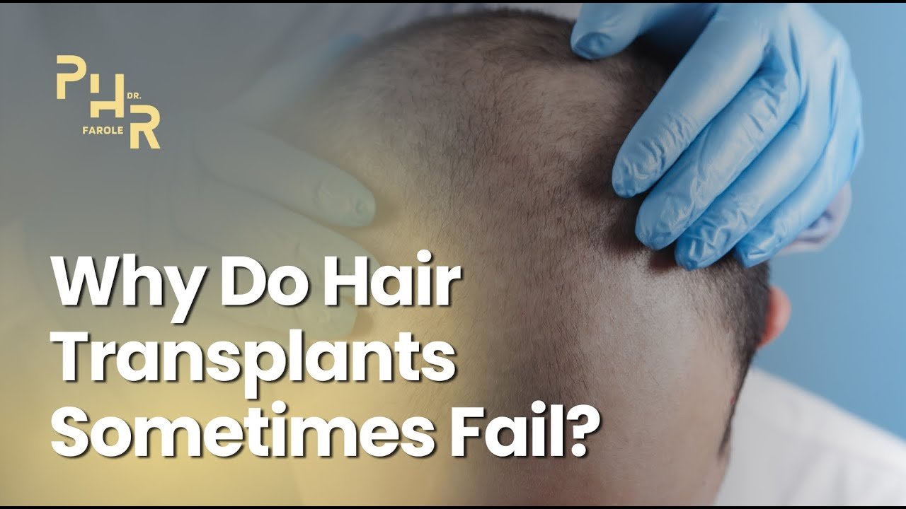 Why Do Hair Transplants Sometimes Fail?
